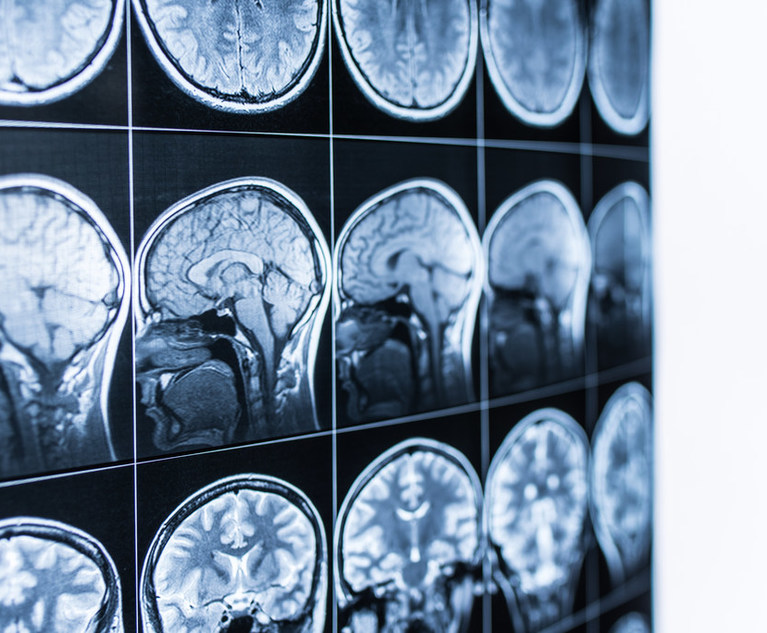 MRI scan of the head and brain of a person in the defocus