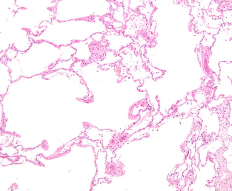 Emphysema