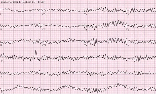 Ventricular fibrillation
