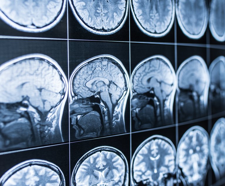 MRI scan of the head and brain of a person in the defocus